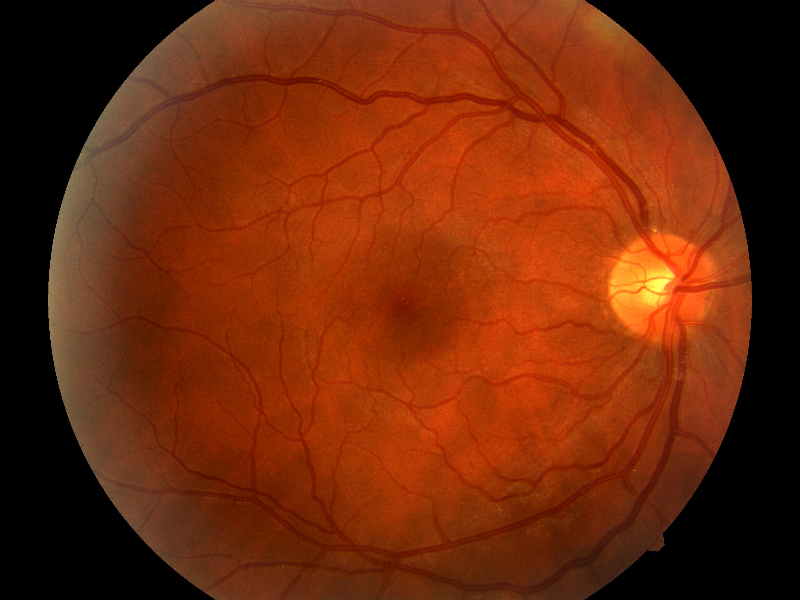 Diabetic Retinopathy