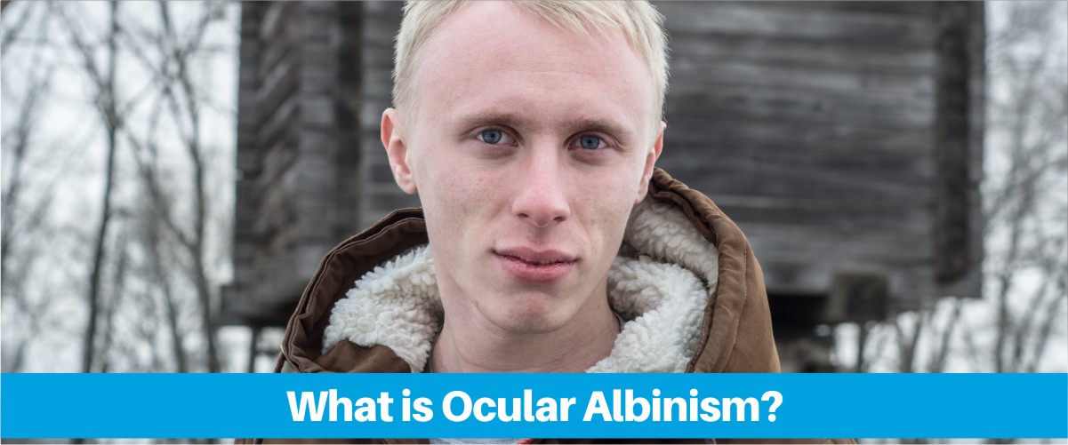 Treatment Options For Ocular Albinism